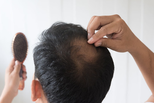 Kenali 5 Jenis Masalah Rambut dan Cara Jitu Mengatasinya!