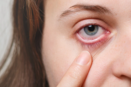 4 Cara Mengatasi Mata Lelah dan Dark Circle, Pilih Eye Care yang Alami!