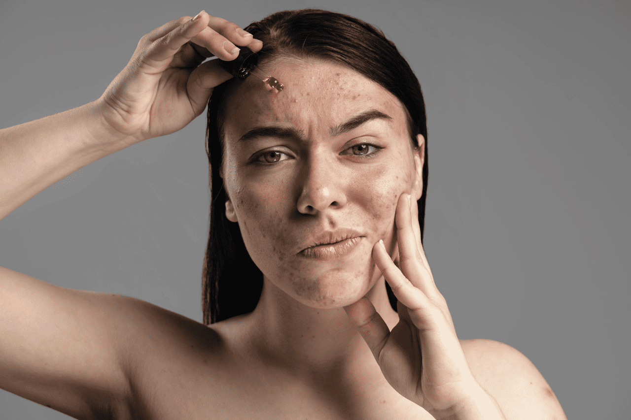 Apa Itu Acne Prone Skin? Kenali Ciri dan Cara Merawatnya