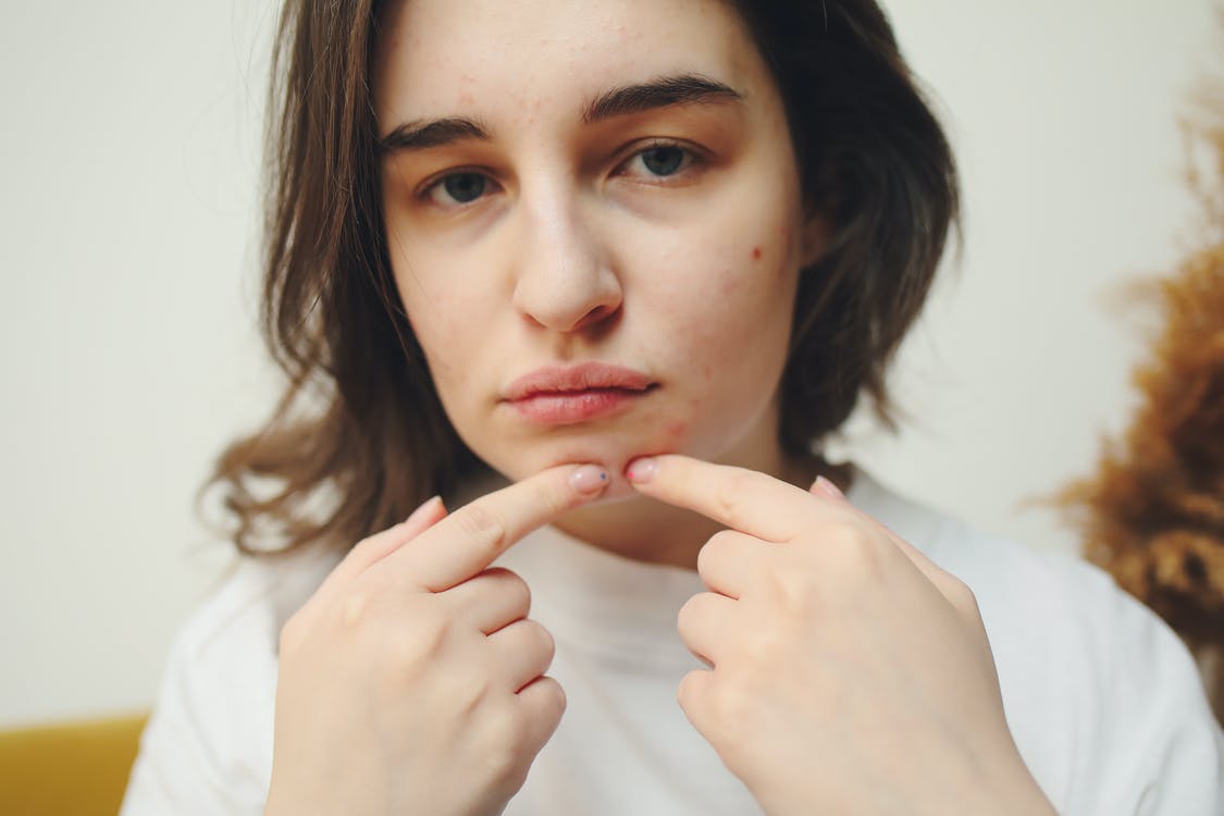 7 Langkah Tuntaskan Acne Prone yang Tak Kunjung Usai