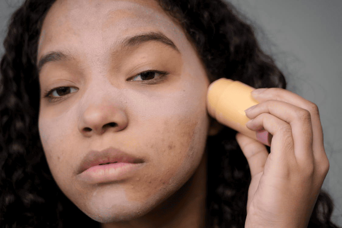 8 Cara Mengatasi Sunburn di Wajah secara Cepat dan Efektif
