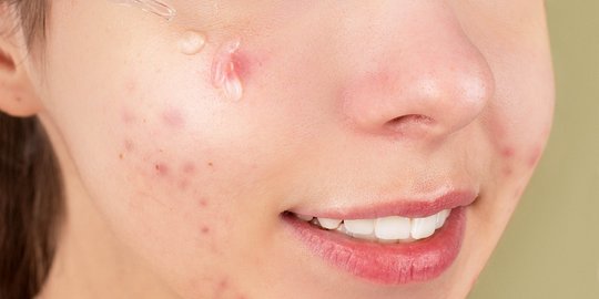 4 Rekomendasi Skincare Ini Adalah Cara Ampuh Menghilangkan Bekas Jerawat Merah