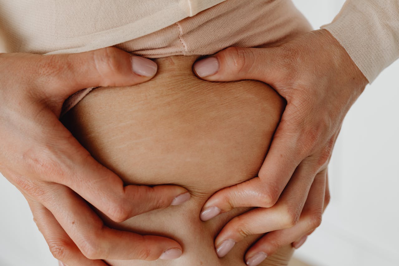 Perbedaan Selulit dan Stretch Mark, Jangan Lagi Keliru!