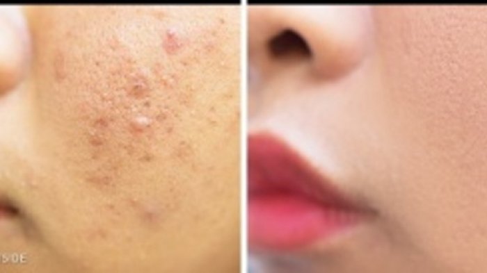 Panduan Menemukan Skincare yang Cocok untuk Menghilangkan Bekas Jerawat